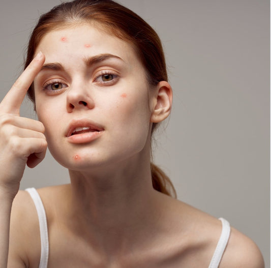 SOS BOUTON! COMMENT S'EN DÉBARRASSER EN 3 ÉTAPES SIMPLES - ZAHKA